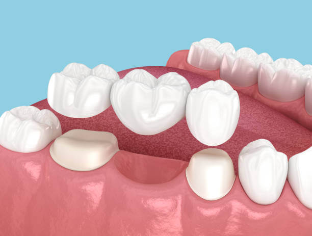 Who Is a Candidate for Dental Bridges in Johns Island? Dentist’s Guide