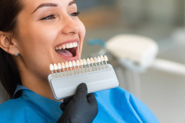 How Long Do Veneers Last in Johns Island? Dentist’s Guide to Durability
