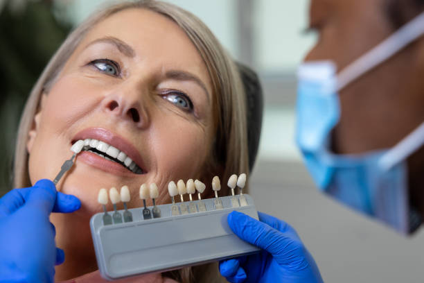 Getting Veneers in Johns Island, SC: Recovery and Aftercare Guide