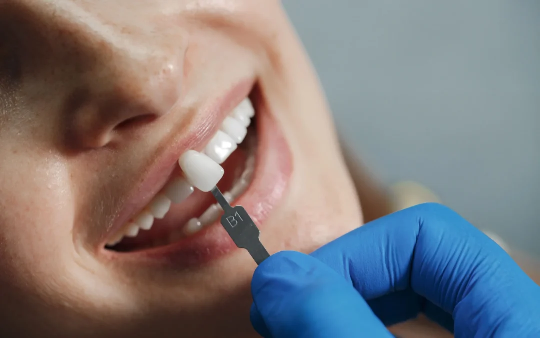 Caring for Your New Veneers: Johns Island Dentist’s Guide