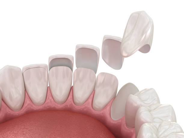 Replacing Old Veneers in Johns Island: What Patients Should Expect