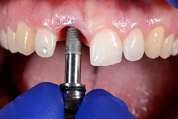 Dental Implant Recovery Timeline: What Johns Island, SC Patients Should Expect