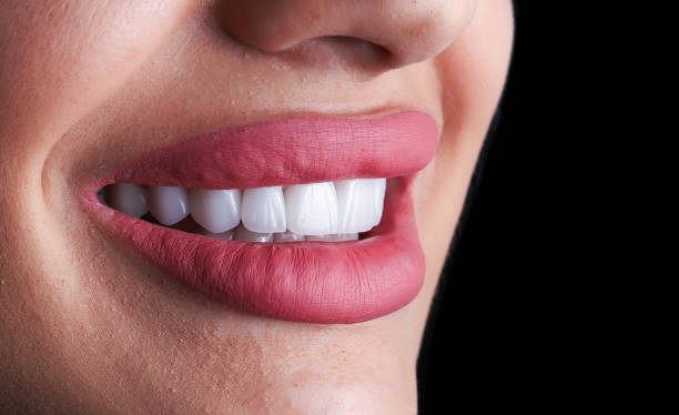 Getting Veneers in West Windsor: Recovery and Aftercare Guide