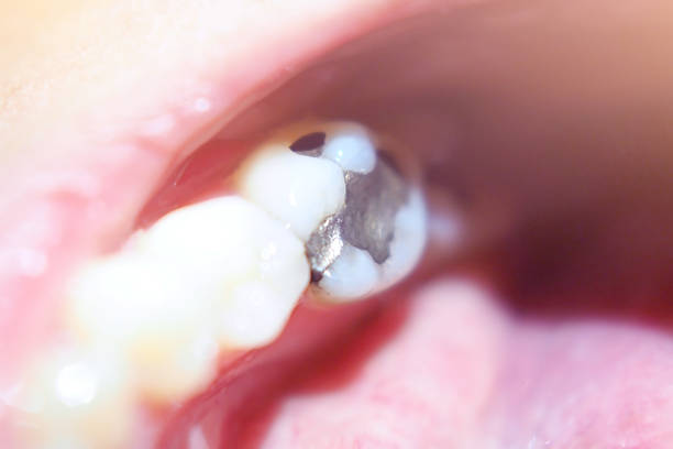 Silver Filling Replacement Process in Johns Island, SC: What to Expect