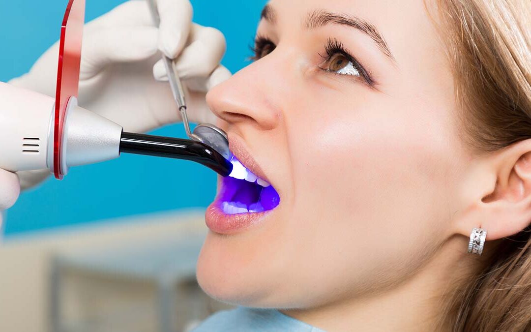 Types of Dental Veneers Available in Johns Island, SC: Expert Guide