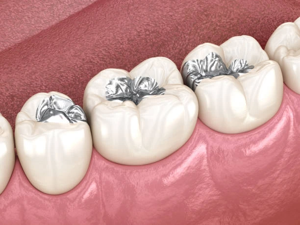 Health Benefits of Replacing Silver Fillings: Johns Island, SC Expert Review