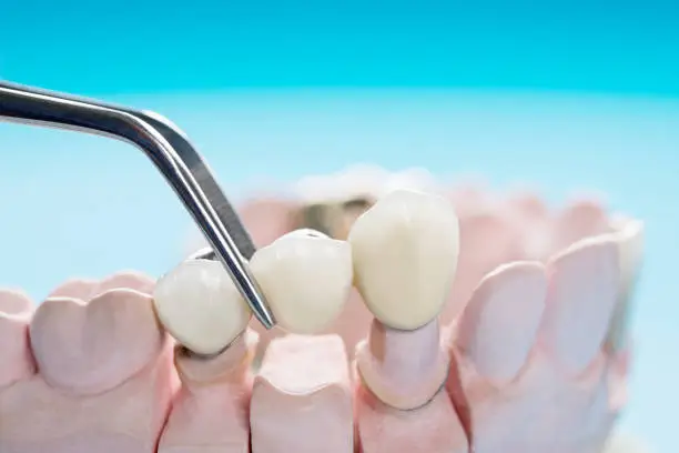 How to Care for a Dental Bridge in Johns Island: Complete Guide