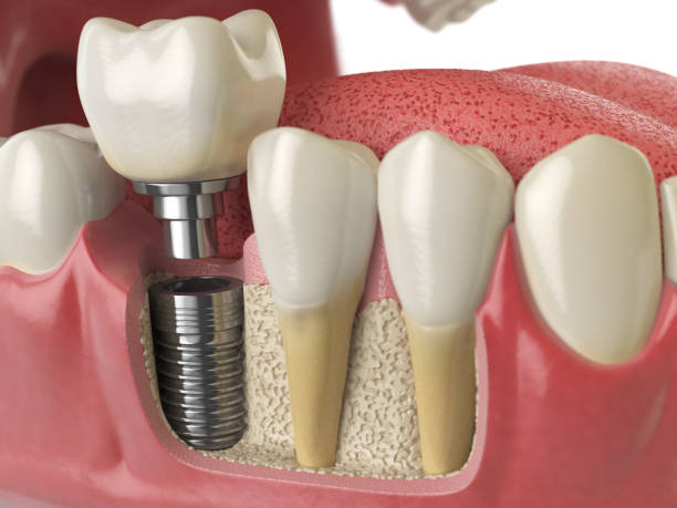How Dental Implants Prevent Bone Loss: Johns Island Dentist Explains